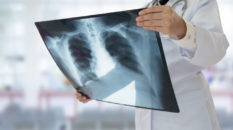 Tumore polmone, studio real life su terapie sequenziali