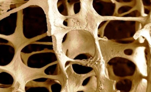 Osteoporosi e fragilità ossea, occhio alle fratture
